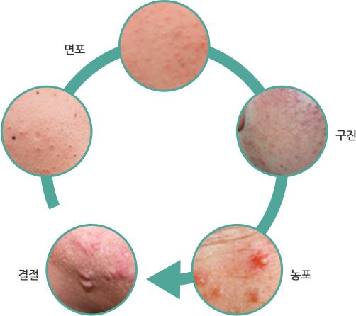 면포→구진→농포→결절